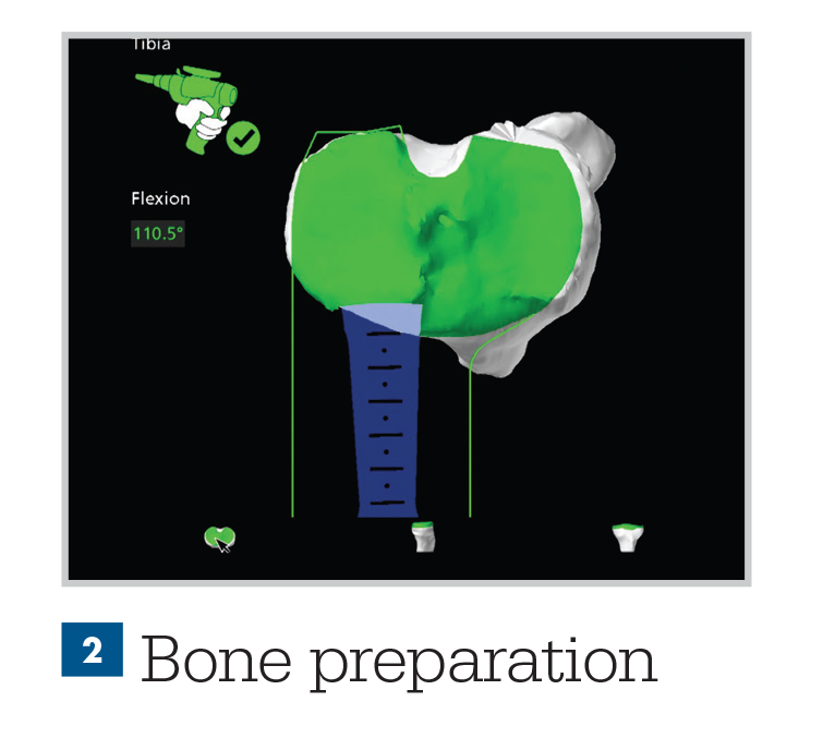 Robotic Assisted Surgery